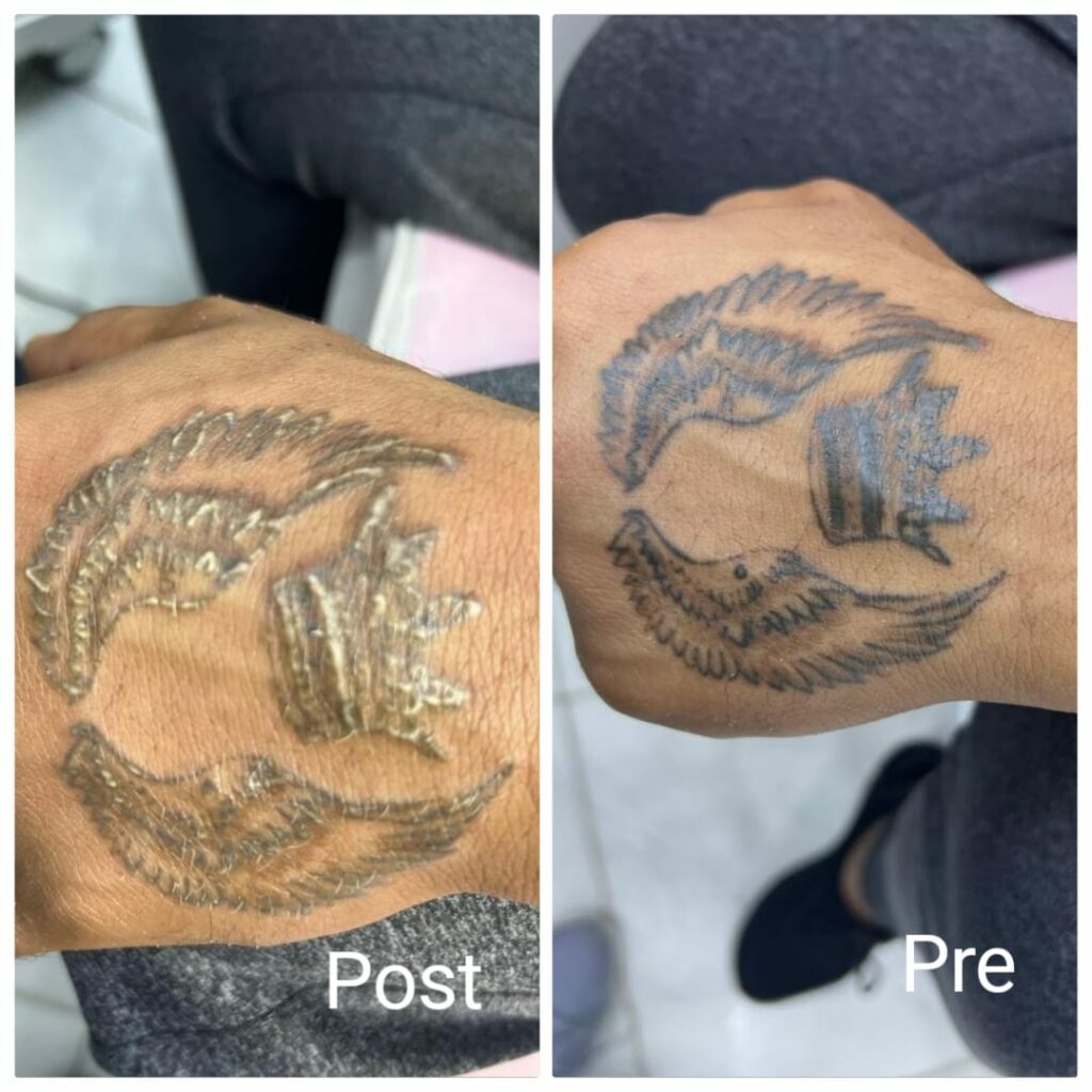 التخلص من التاتو